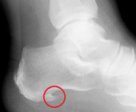 Posterior Calcaneal Spur