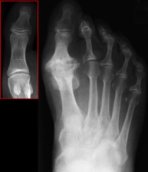 X-ray showing arthritis of the big toe. Image in the red box shows a normal big toe x-ray.