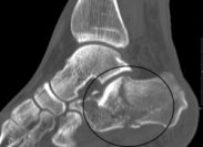 Posterior Calcaneal Spur