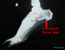 Heel Spur