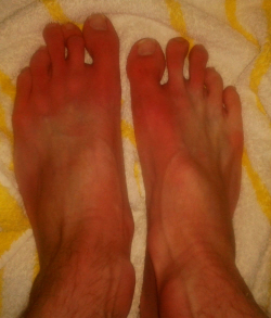 Bottom of Feet Red Upon Waking | Institute for Preventive ...