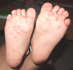 Different Foot Rashes | LIVESTRONG.COM