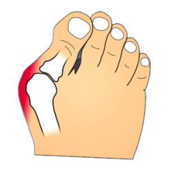 Bunions Callous