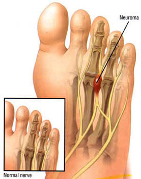 What are some causes of foot pain in the arch area?