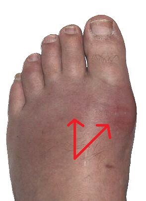 How is pain from red swollen toes treated?