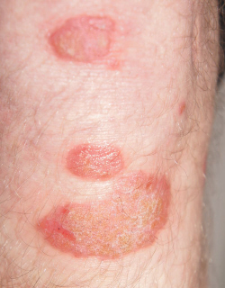 Red patch on foot - Free Download - www.pancration.nl ...