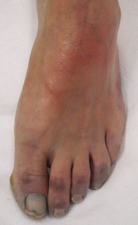 Diabetic Blisters On Foot Pictures, Images ... - Photobucket