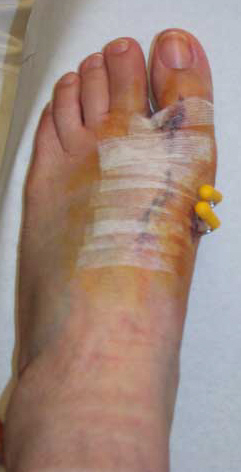 How long does it take you to heal after bunion surgery?