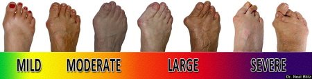 bunions foot bunion symptoms pain know rid toe feet severe something does treatment painful mild things progression scale why valgus
