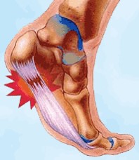 How do you treat bone spurs in the feet?