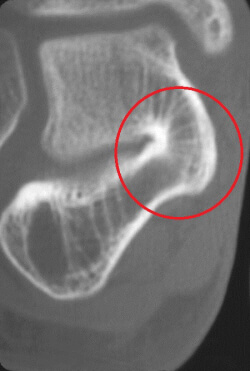 Tarsal Coalition is where two bones are joined by an excess bridge of bone Tarsal Coalition is where two bones are joined by an excess bridge of bone