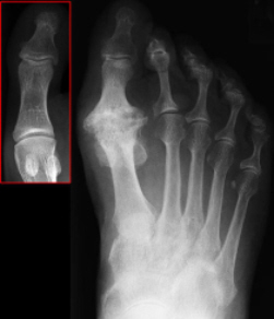 Big toe arthritis steroid injection