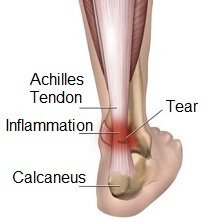 Image result for achilles tendon