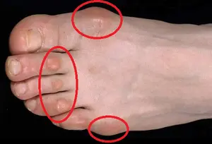 lump on toes 475 opt feb 26