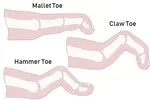hammer mallet claw toe 420 opt may 19