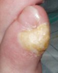 Foot corn causing pain on outside of foot