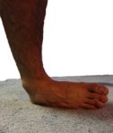 An inversion injury often results in pain on side of foot from an ankle sprain