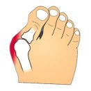 Bunions, aka hallux abducto valgus, are a common cause of pain on the outside of the foot