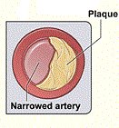 Diagram showing typical plaque formation in peripheral artery disease which reduces blood flow