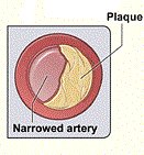 Diagram showing typical plaque formation in peripheral artery disease which reduces blood flow Diagram showing typical plaque formation in peripheral artery disease which reduces blood flow