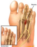Morton's Neuroma commonly causes pain, tingling and numbness between the toes