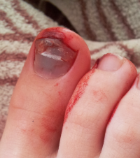 Tennis Toe is a common cause of toe pain with blood pooling under the nail