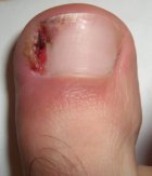 An ingrown toenail develops when the curled sides of the nail push into the surrounding skin caused toe pain and inflammation