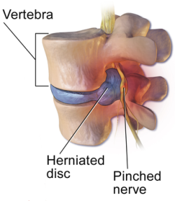 A slipped disc can cause numb feet