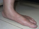 Posterior Tibial Tendionitis is linked with flat feet
