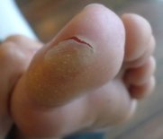 Blisters are a common cause of pain in toes