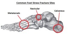 Common sites of stress fractures of the foot
