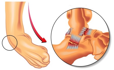 Common Foot Injuries and their Treatment with Physio - Glebe Physio