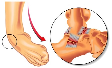 Heel pain | Treatment & Causes | The Feet People Podiatry