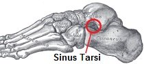 Sinus Tarsi Syndrome causes pain over the outer side of the foot Sinus Tarsi Syndrome causes pain over the outer side of the foot