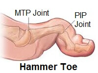 Yoga Toe Toe Stretchers Foot Pain Explored