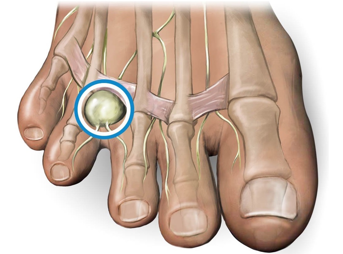 Lump On Toe Causes And Treatment For Toe Lumps And Bumps