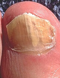 Fungal nail infections often result in thick, yellow toenails Fungal nail infections often result in thick, yellow toenails