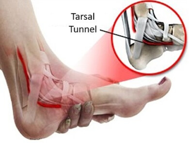 Tarsal Tunnel Syndrome: Pain on side of heel, tingling and numbness Tarsal Tunnel Syndrome: Pain on side of heel, tingling and numbness