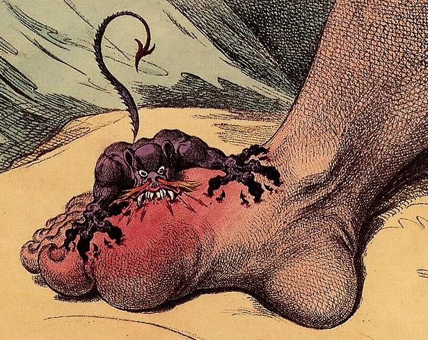 Gout foot is a common cause of toe swelling which can spread through the foot