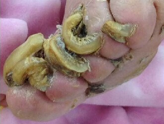 Thick Toenails: Diagnosis & Treatment - Foot Pain Explored