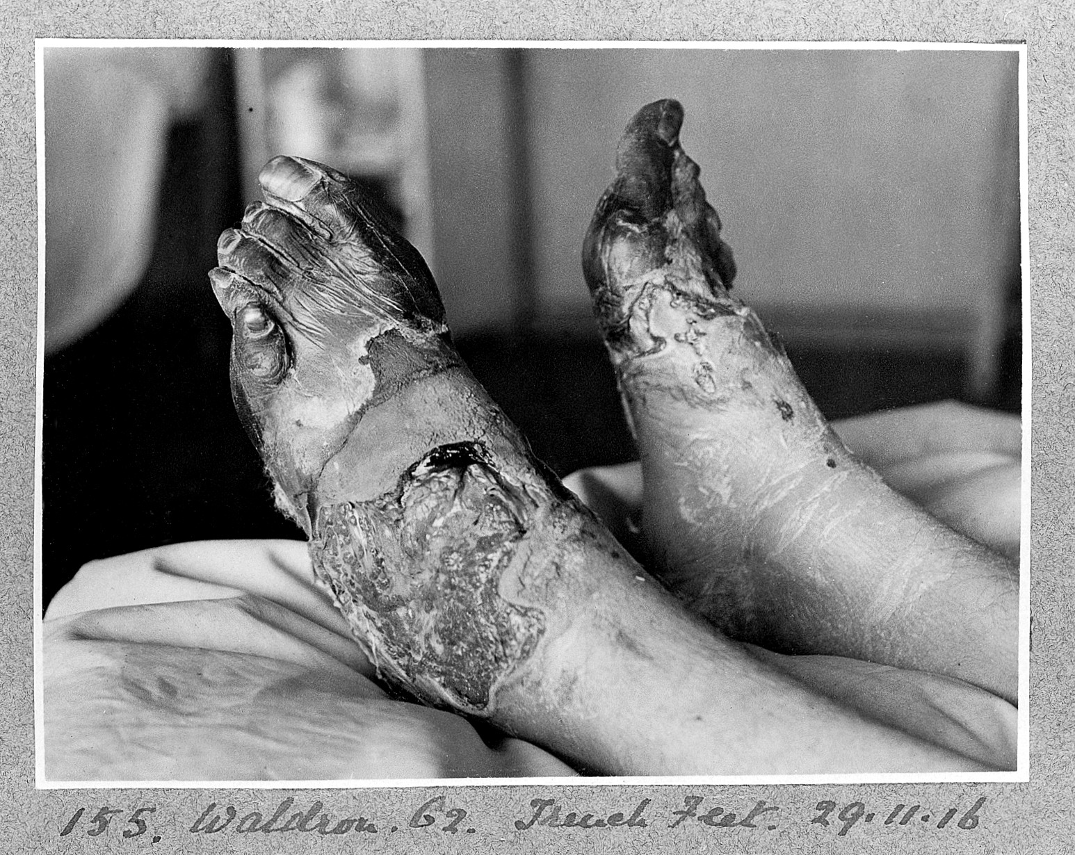 Trench Foot: Photo of an unidentified WW1 soldier with Crumpet Foot Trench Foot: Photo of an unidentified WW1 soldier with Crumpet Foot