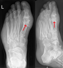 Foot Gout & Podagra: Prevention, Diagnosis & Treatment
