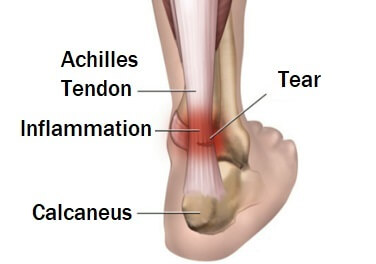 Achilles Tendon Pain: Causes, Diagnosis and Treatment