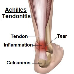 calcaneus hurts