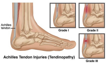 stiff painful achilles tendon