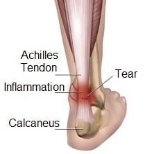 pain in bottom of achilles tendon