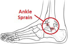 Foot & Ankle Pain Running: Causes &