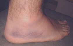 Initial ankle sprain treatment aims to reduce pain and swelling Initial ankle sprain treatment aims to reduce pain and swelling