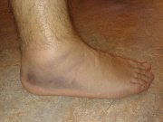 pain on outside of foot pain on outside of foot