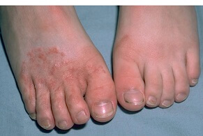 Athletes foot is a fungal infection on the skin. Find out about the causes, symptoms, diagnosis & treatment options
